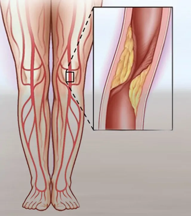 İliak Arter (Bacak atardamarı) Balon / Stent Uygulamaları