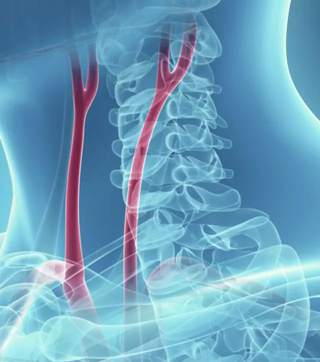Karotis Arter (Beyine giden atardamar) Balon / Stent Uygulamaları