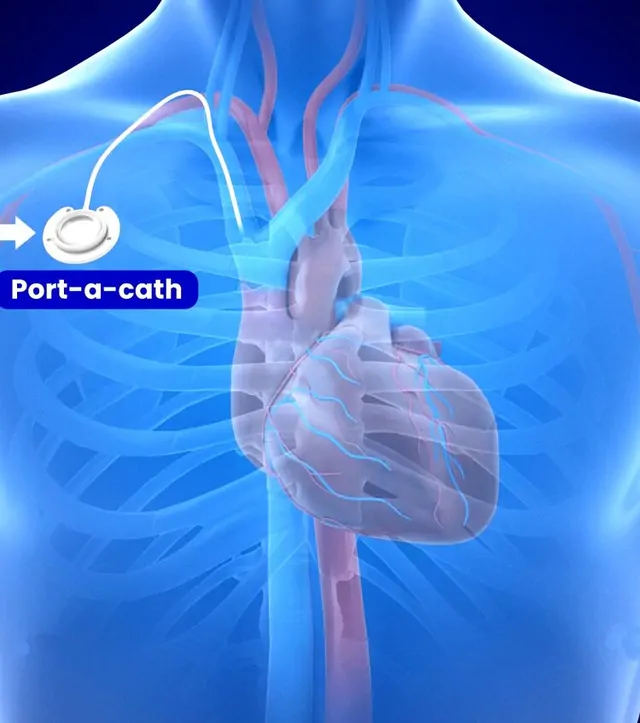 Port Kateteri Yerleştirmesi