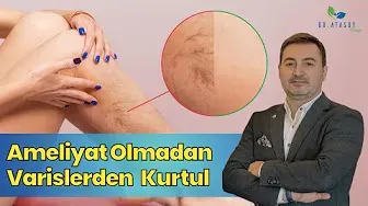 DEVRİM NİTELİĞİNDE VARİS TEDAVİSİ: AMELİYATA GEREK YOK!